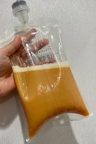 血液淨化療程中的廢液，顯示液體顏色與分層情況。