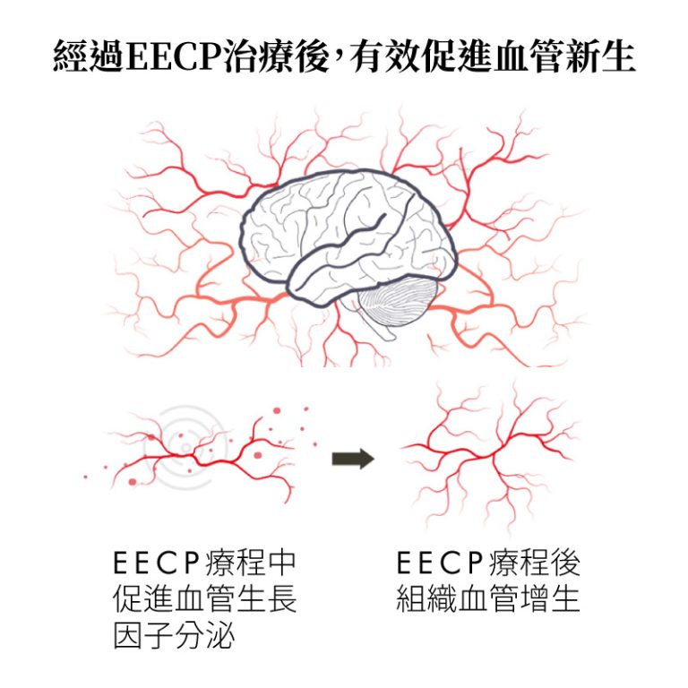 EECP體外反搏治療促進血管新生，提升腦部血液循環，有助於預防中風與改善認知功能。